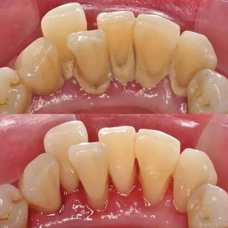 Teeth Scaling and Polishing treatment image